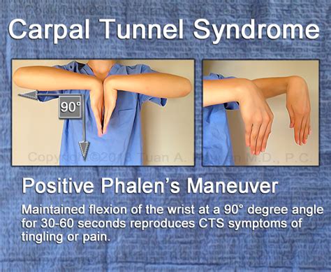 effect of the median nerve compression test|positive phalen's test.